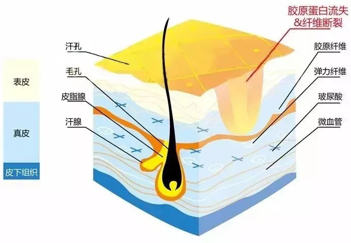 凹陷疤痕形成原理