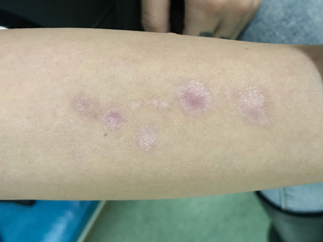 烧伤疤痕